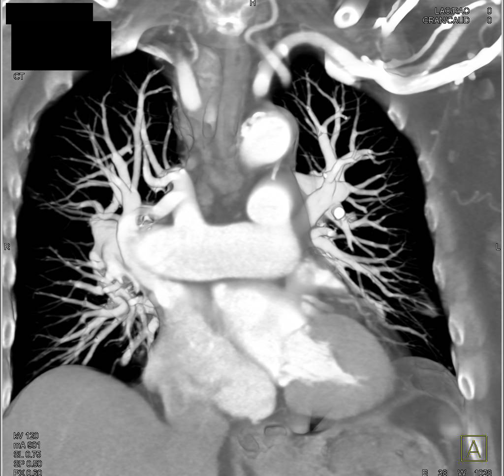 Dilated Right Pulmonary Artery - CTisus CT Scan