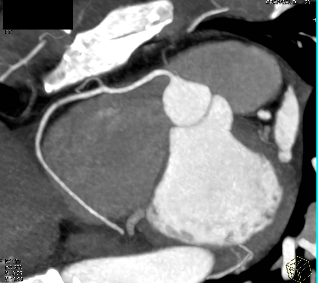 CCTA: Normal Right Coronary Artery (RCA) - CTisus CT Scan