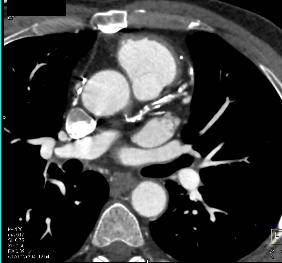 CCTA: High Grade Left Anterior Descending Coronary Artery (LAD) Stenosis - CTisus CT Scan