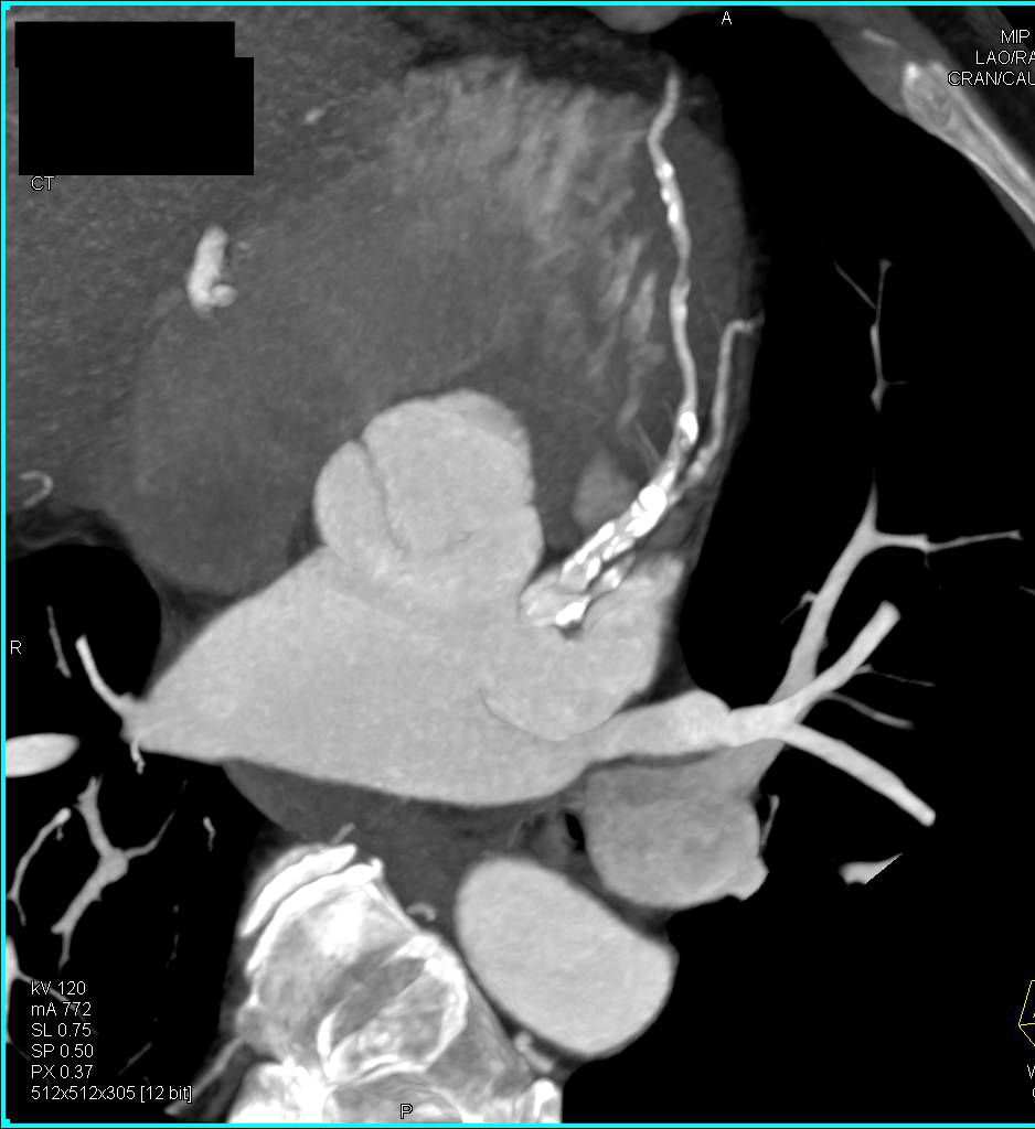 CCTA: Extensive Left Anterior Descending Coronary Artery (LAD) Disease with Calcified Plaque - CTisus CT Scan