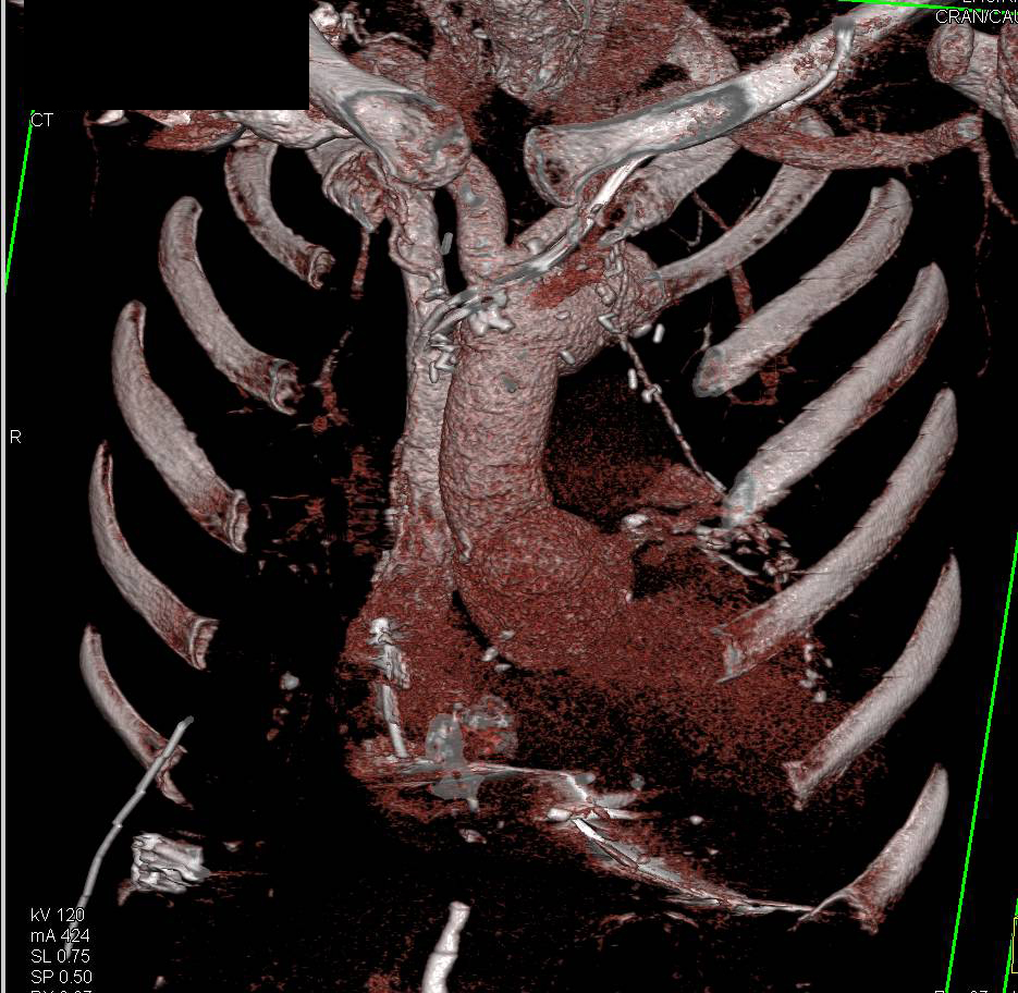 CCTA: Left Internal Mammary Artery (LIMA) Graft - CTisus CT Scan