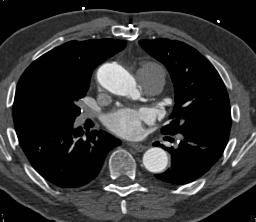 Composite Graft with Aortic Valve Replacement (AVR) - CTisus CT Scan