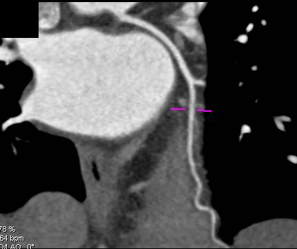 CCTA: Normal Right Coronary Artery (RCA) - CTisus CT Scan