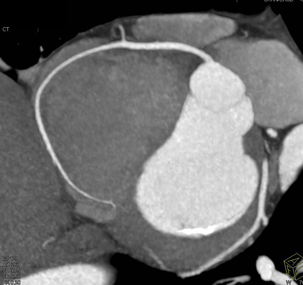 CCTA: Normal Coronary CTA in Multiple Perspectives and Renderings - CTisus CT Scan