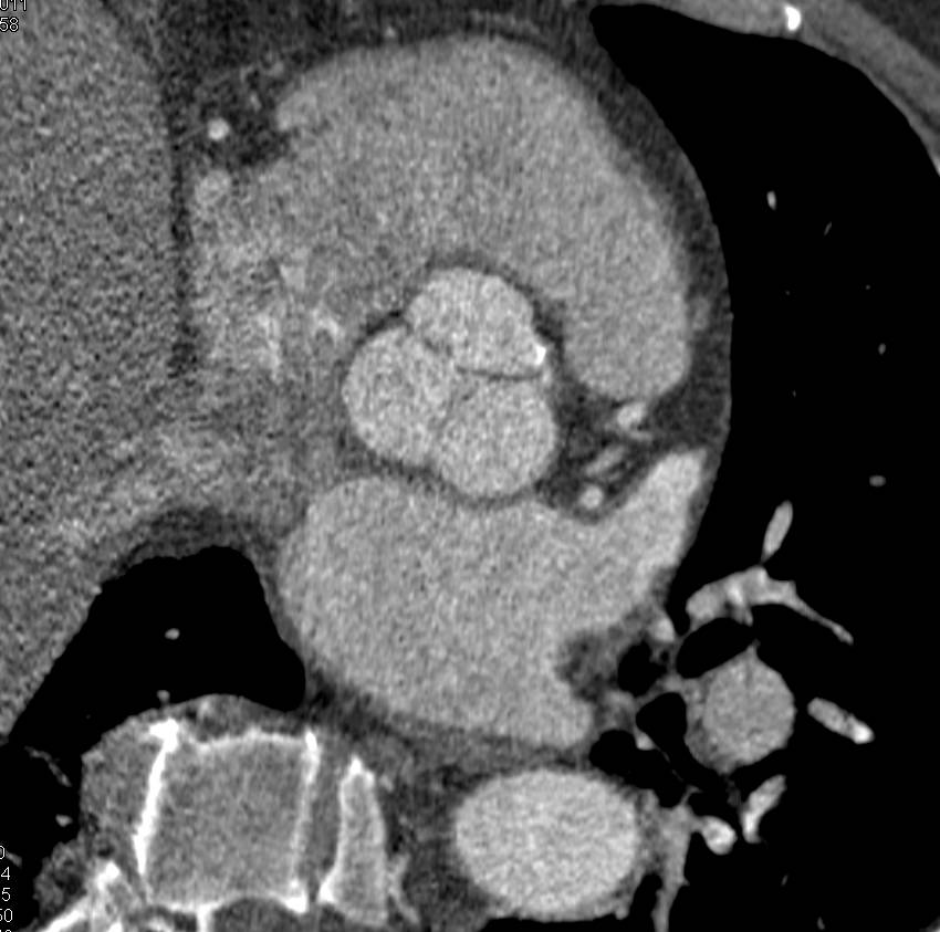 Dilated Aortic Root and Ascending Aorta with Aortic Valve Disease - CTisus CT Scan