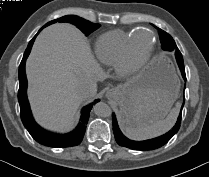 Incidental Left Ventricular Aneurysm - CTisus CT Scan