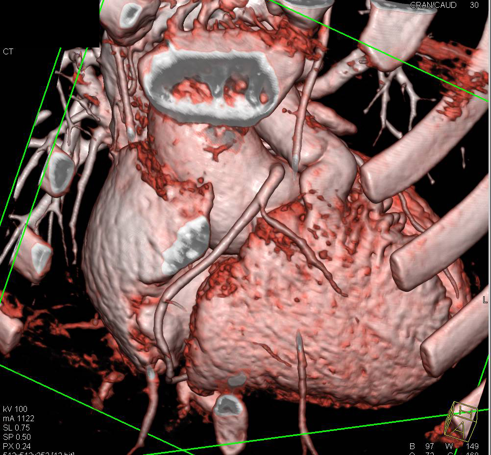 Thickened Trabeculae Right Ventricle - CTisus CT Scan