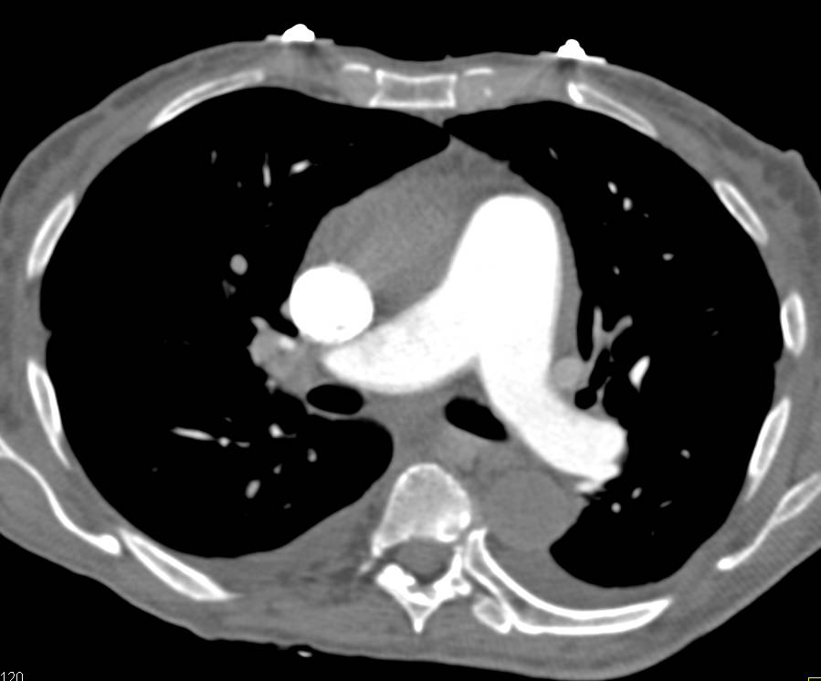 Poor Right Sided Heart Function with Reflux of Contrast into the Inferior Vena Cava (IVC) and Hepatic Veins - CTisus CT Scan