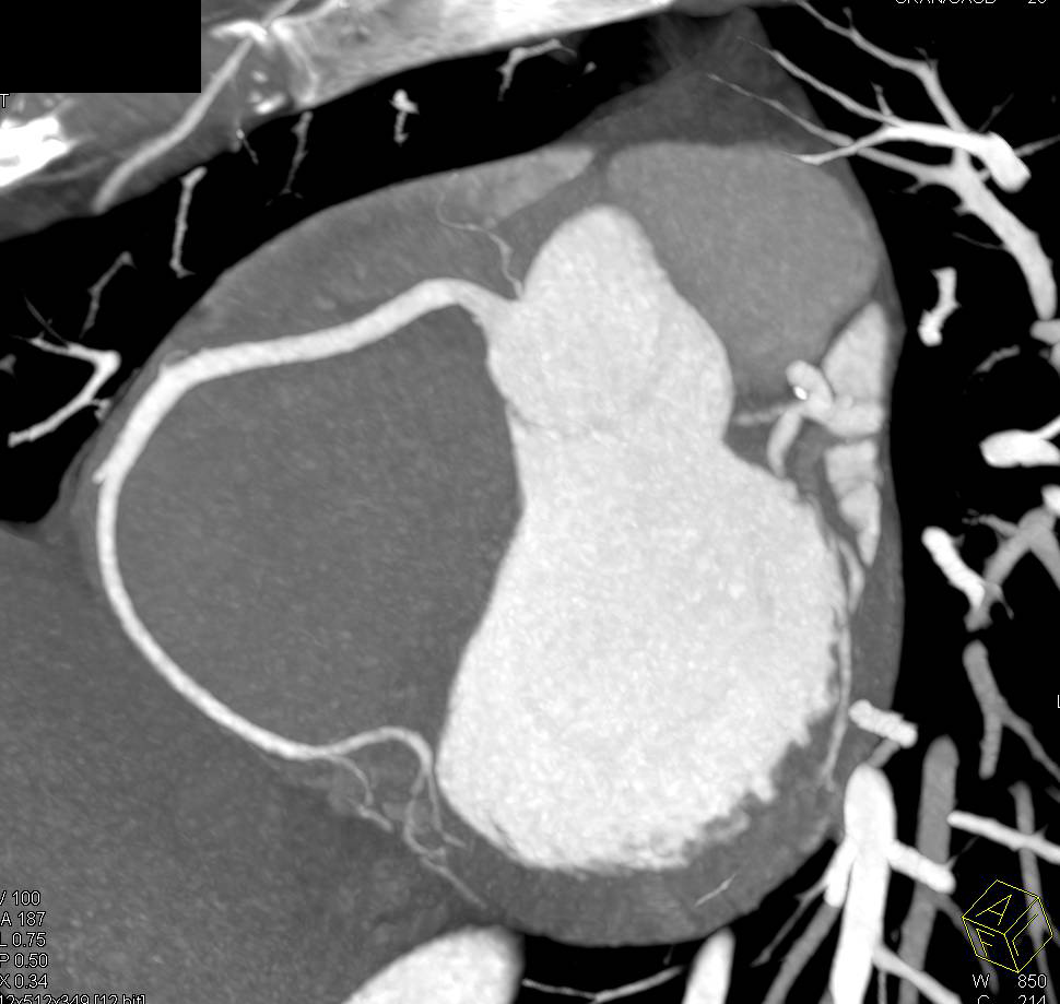 CCTA: Minimal Left Anterior Descending Coronary Artery (LAD) Plaque - CTisus CT Scan