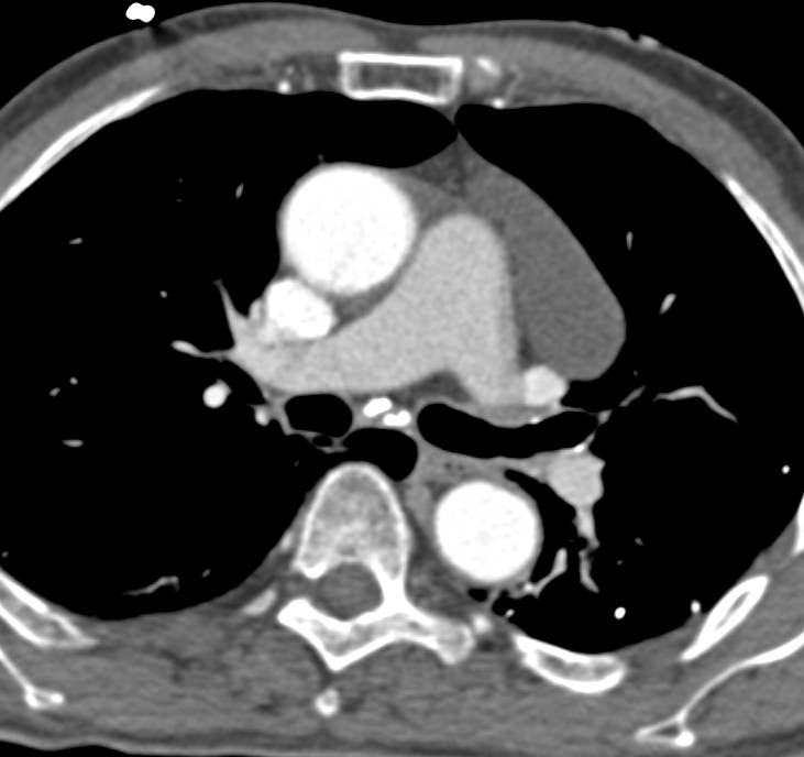 Pericardial Cyst - CTisus CT Scan