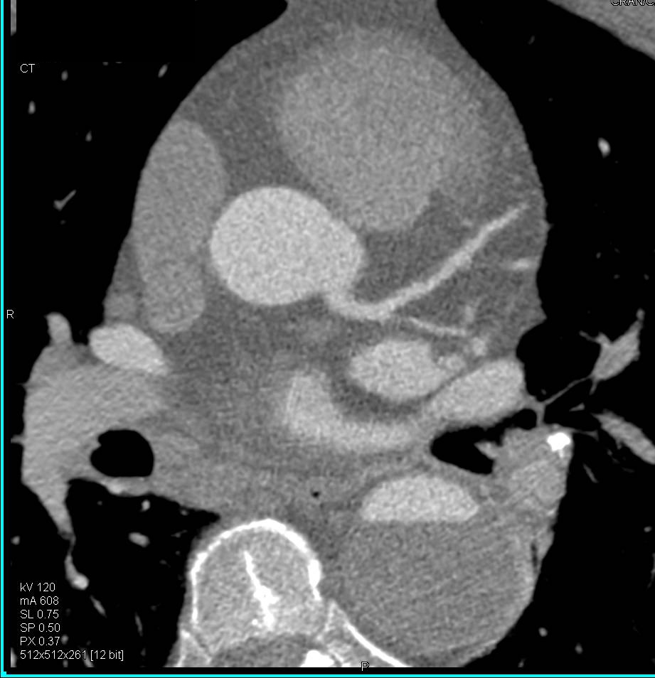 CCTA: Noncalcified Plaque in the Left Anterior Descending Coronary Artery (LAD) - CTisus CT Scan