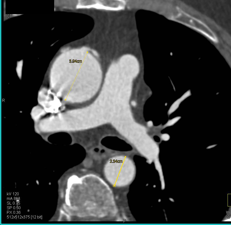 3D Map of Coronary Artery Bypass to Left and Right Circulation - CTisus CT Scan