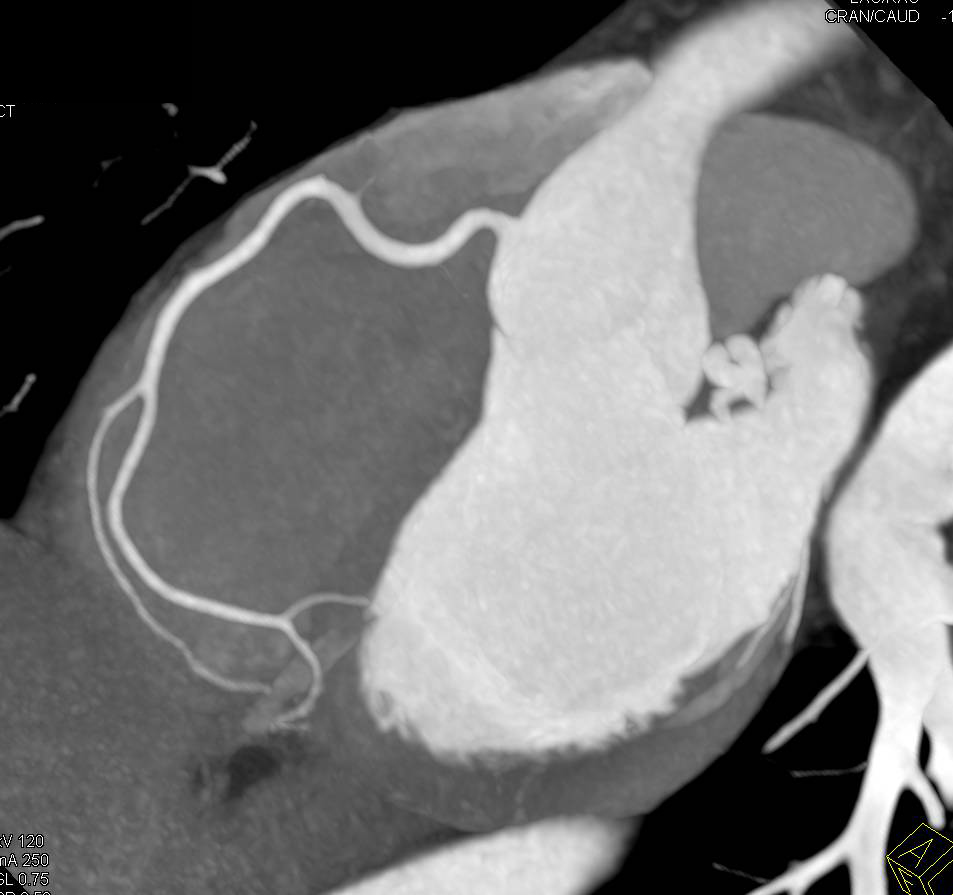 CCTA: Normal Coronary CTA in Multiple Perspectives and Renderings - CTisus CT Scan