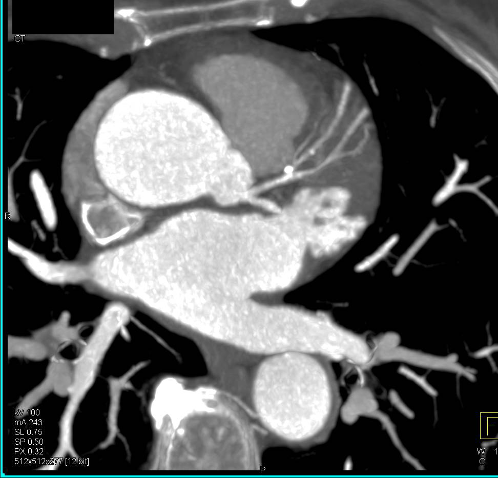 CCTA: Plaque Left Anterior Descending Coronary Artery (LAD) without Critical Stenosis - CTisus CT Scan