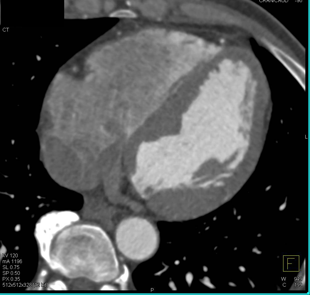 CCTA: Minimal Plaque Right Coronary Artery (RCA) - CTisus CT Scan