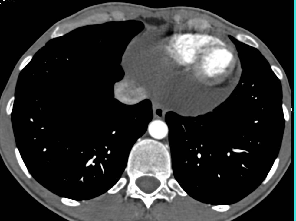 Pericardial Effusion and Incidental Hepatic Hemangioma - CTisus CT Scan