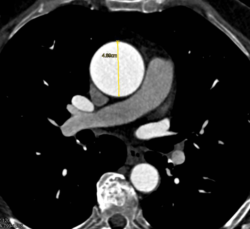 Aortic Valve Disease with Dilated Ascending Aorta - CTisus CT Scan