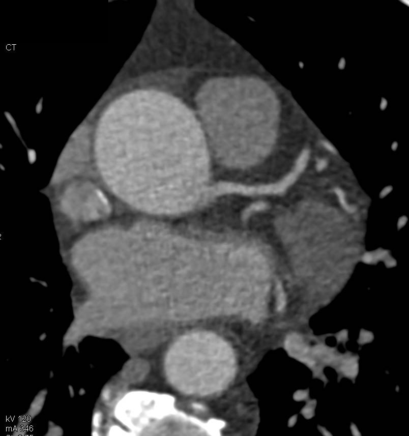 Extensive Aortic Valve Calcification - CTisus CT Scan