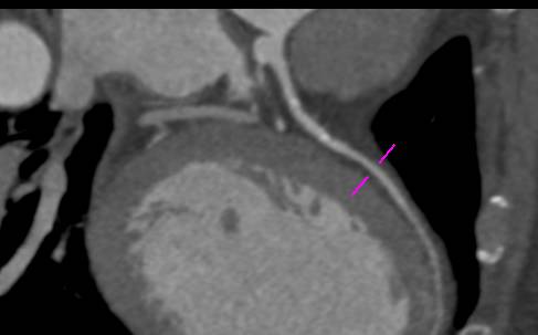 CCTA: Left Anterior Descending Coronary Artery (LAD) with Minimal Plaque - CTisus CT Scan