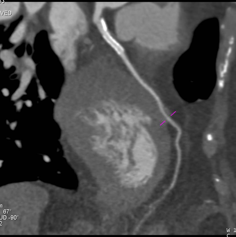 CCTA: Stent in the Left Anterior Descending Coronary Artery (LAD) - CTisus CT Scan