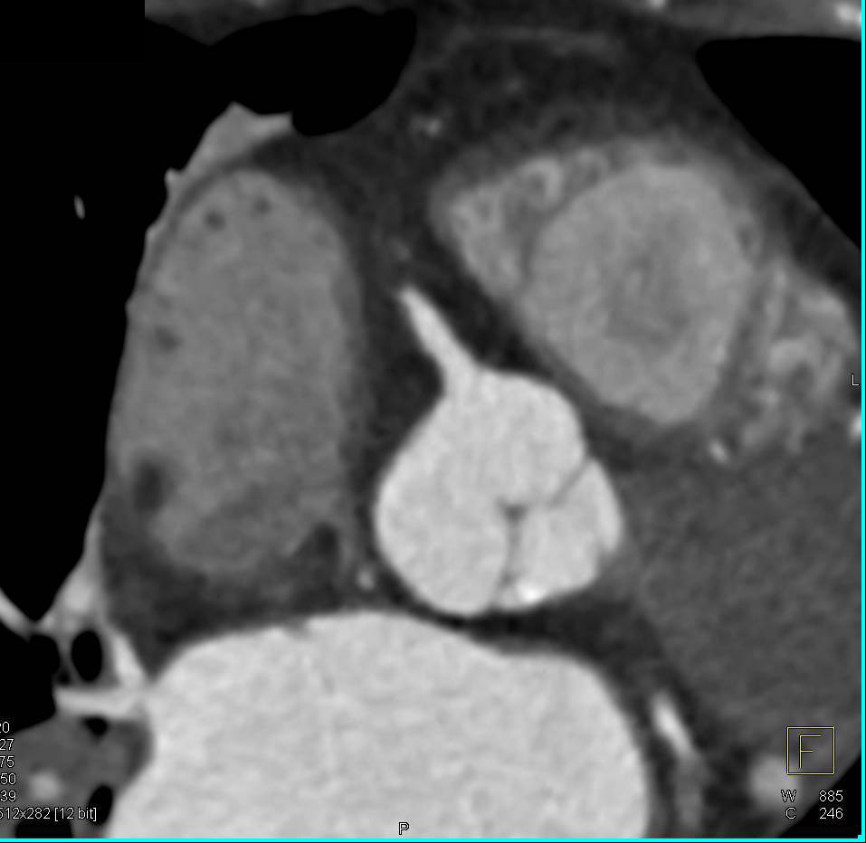 CCTA: Multi-Vessel Disease with Stent in the Left Anterior Descending Coronary Artery (LAD) - CTisus CT Scan