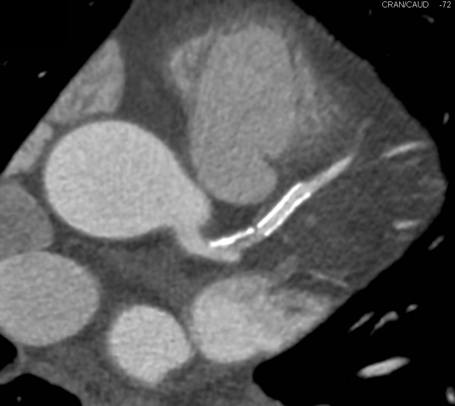 CCTA: Patent Stent in the Left Anterior Descending Coronary Artery (LAD) - CTisus CT Scan