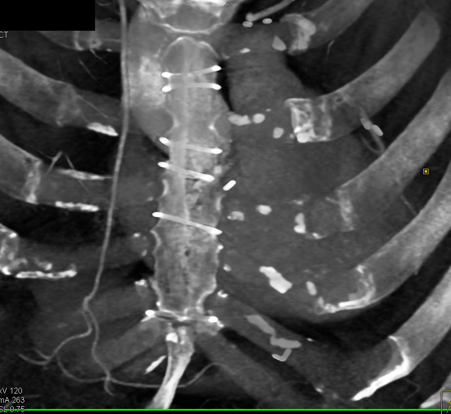 Left Internal Mammary Artery (LIMA) Graft in 3D - CTisus CT Scan