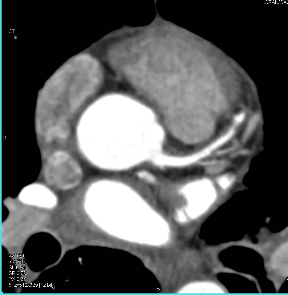 CCTA: Left Anterior Descending Coronary Artery (LAD) Plaque with a normal Agatston Score - CTisus CT Scan