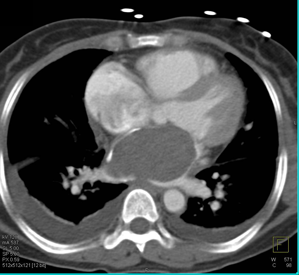 Left Atrial Myxoma - CTisus CT Scan