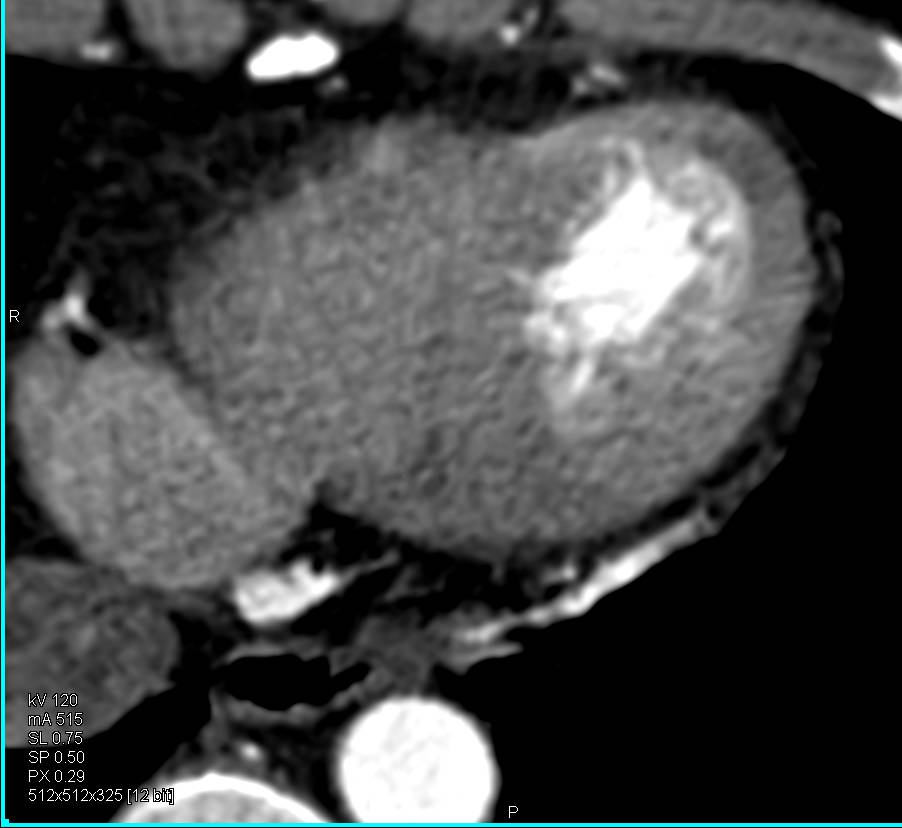 Left Ventricular Infarct - CTisus CT Scan