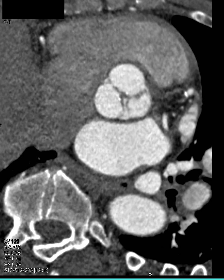 Mild Aortic Valve Thickening with Calcification - CTisus CT Scan