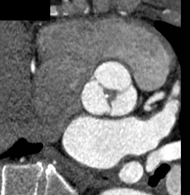 What Is Mild Aortic Calcification