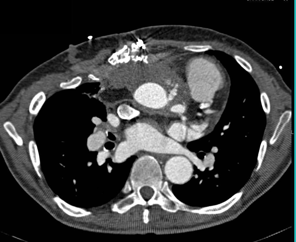 Repair of Aortic Root with Leak at Anastomotic Site - CTisus CT Scan