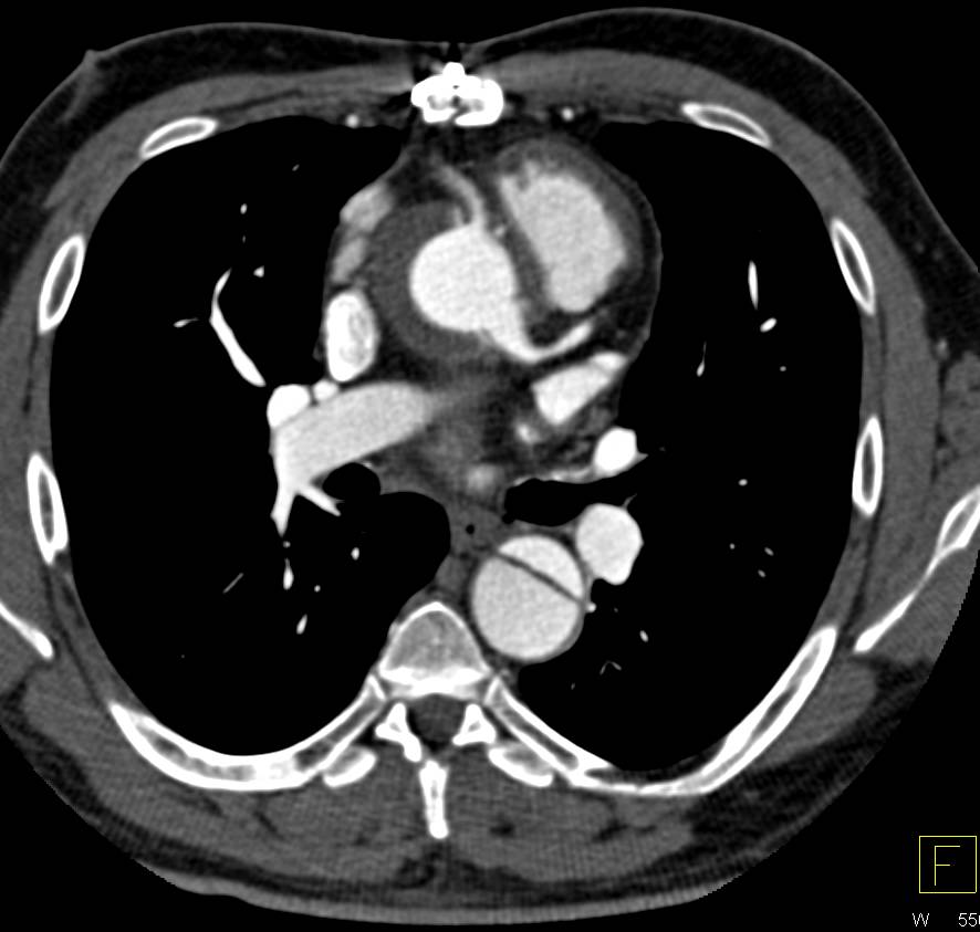 Aortic Root Repair with Reimplanted Coronary Arteries and now Type B Dissection - CTisus CT Scan