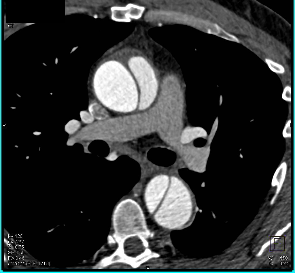 Type A Dissection with a Gated Acquisition - CTisus CT Scan