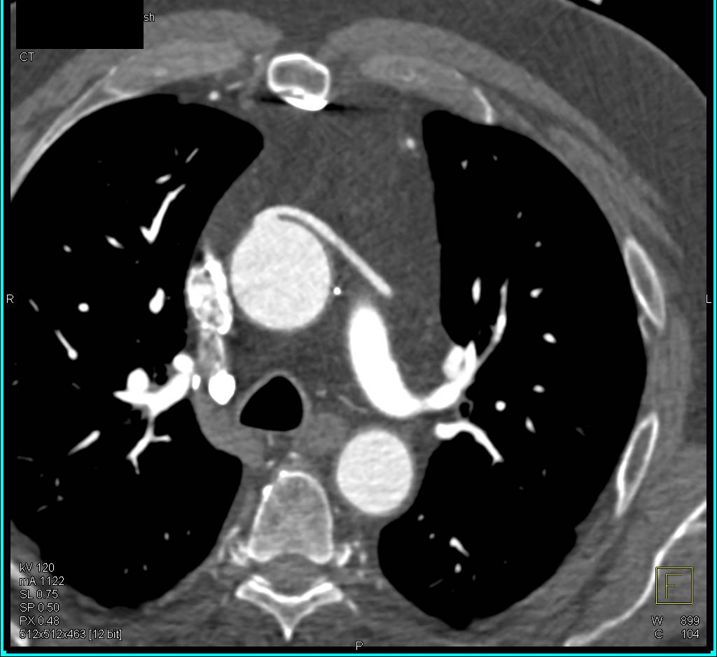 CTA with 2 Bypass Grafts Following Coronary Artery Bypass Graft (CABG) Nicely Seen and Patent - CTisus CT Scan