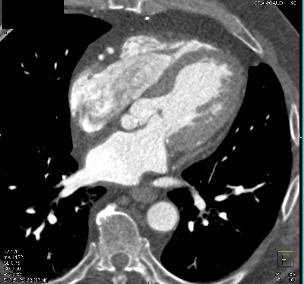 Cardiac CTA with 2 Venous Grafts as well as a Left Internal Mammary Artery (LIMA) Graft - CTisus CT Scan