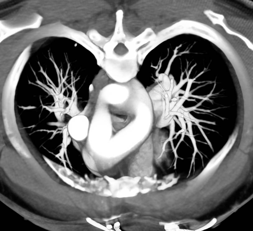 right aortic arch with mirror image branching
