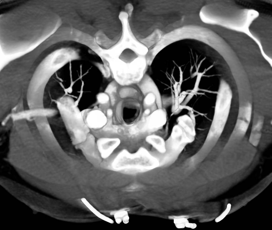 aortic arch ct