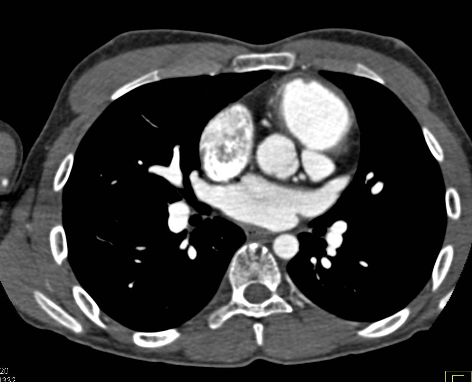 Enlarged Main Pulmonary Artery - CTisus CT Scan