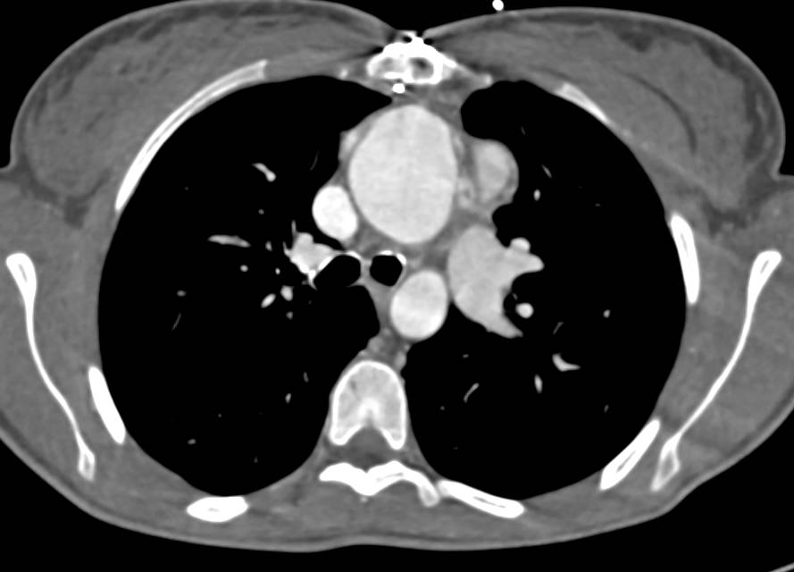 CCTA with the Circumflex Arising off the Right Coronary Artery - CTisus CT Scan