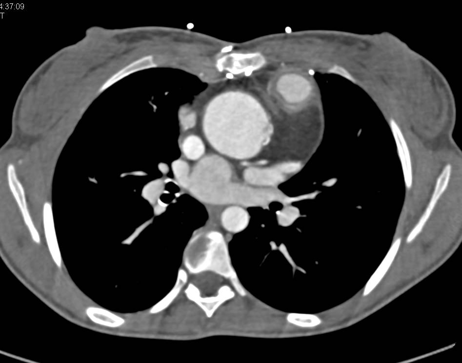 Vascular Bypass off the Pulmonary Artery - CTisus CT Scan