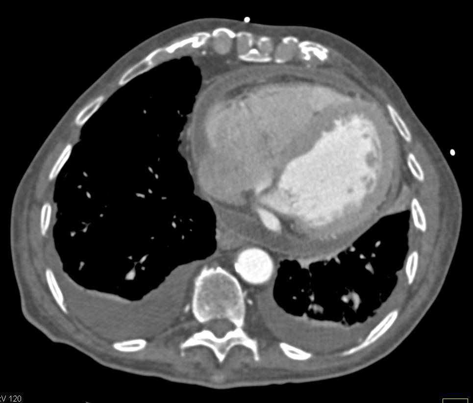 Pericarditis with Thickened Pericardium - CTisus CT Scan