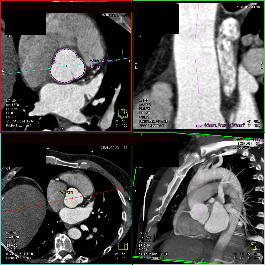 Dilated Aortic Root with Center Line Measurements - CTisus CT Scan