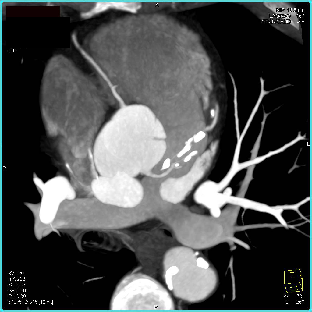 CCTA: Critical Stenosis in Left Anterior Descending Coronary Artery (LAD) and Right Coronary Artery (RCA) - CTisus CT Scan