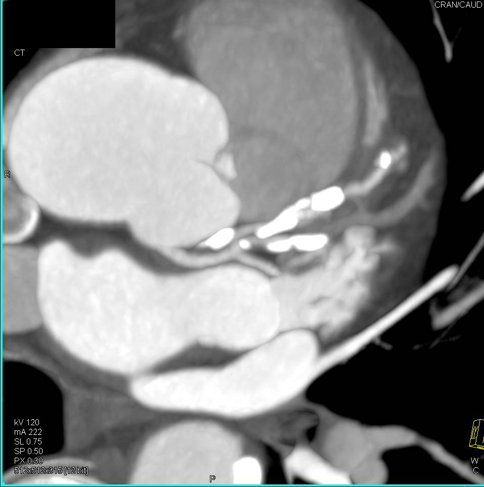 CCTA: Multivessel Disease with Extensive Calcified Plaque in Left Anterior Descending Coronary Artery (LAD) - CTisus CT Scan