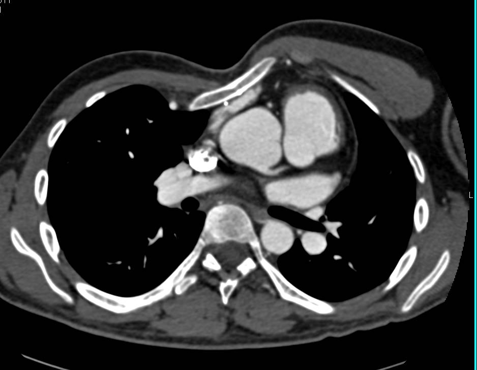 Marfan with Pectus Deformity and Dilated Aortic Root - CTisus CT Scan