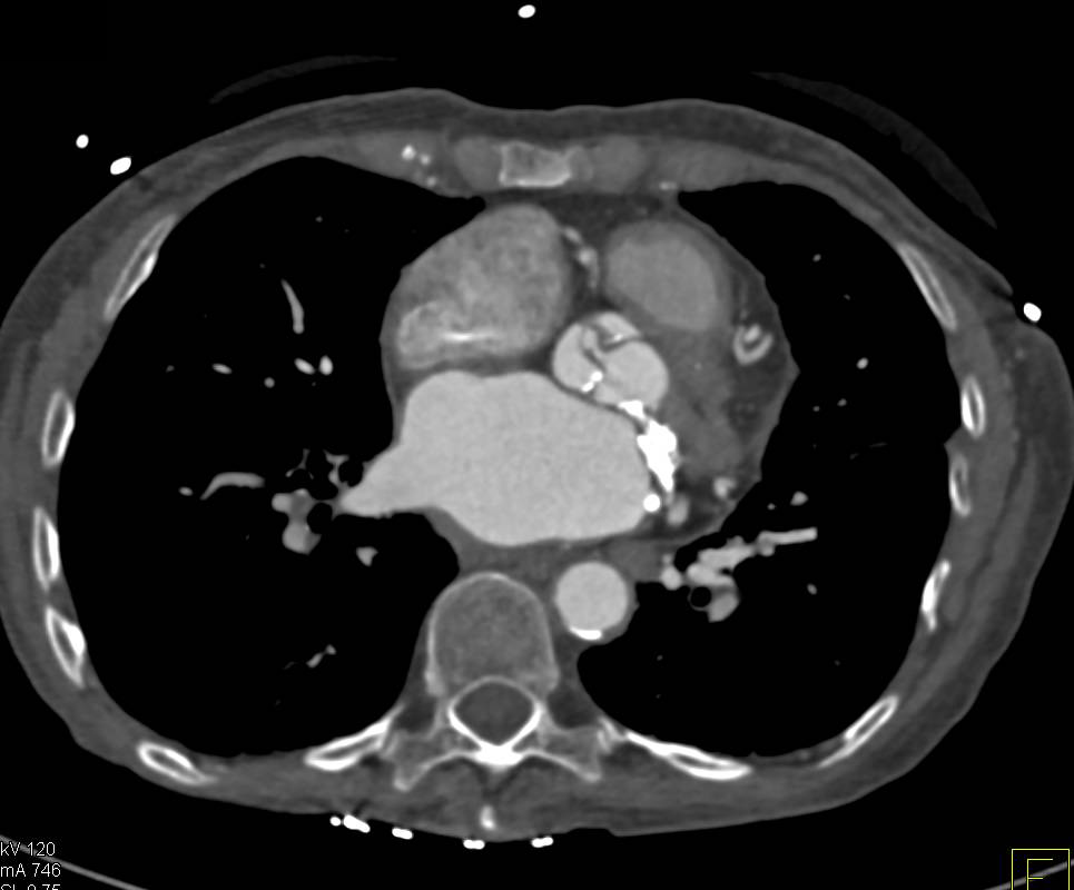 Aortic Valve Calcification C/W Aortic Stenosis - CTisus CT Scan