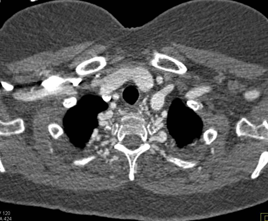 Aortic Occlusion with Almost Similar Appearance to a Coarctation - CTisus CT Scan