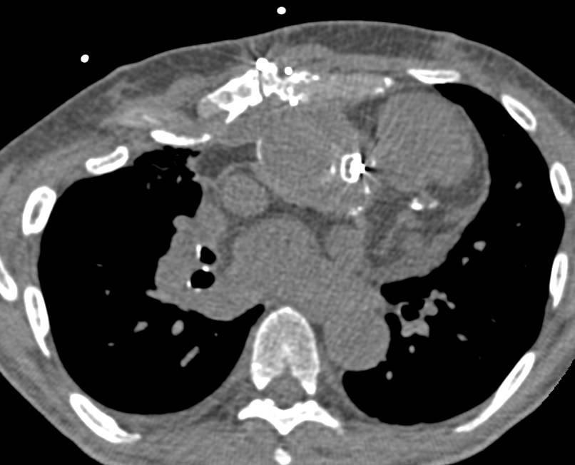 Repair of Pseudoaneurysm off Aortic Root Following Root Replacement - CTisus CT Scan